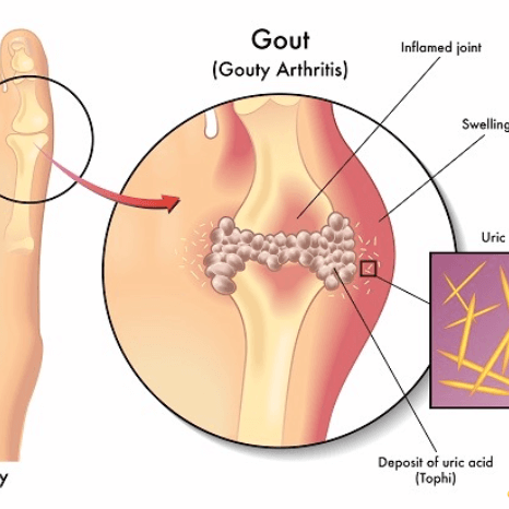 Gout Medication, Gout Medications Coupons
