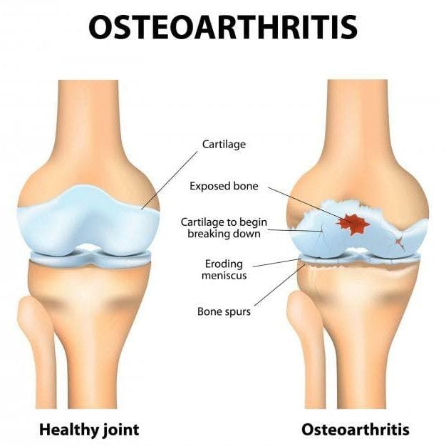 Osteoarthritis Medication, Osteoarthritis Medications Coupons