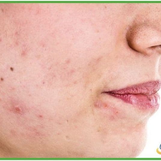 Acne Medication, Acne Medications Coupons