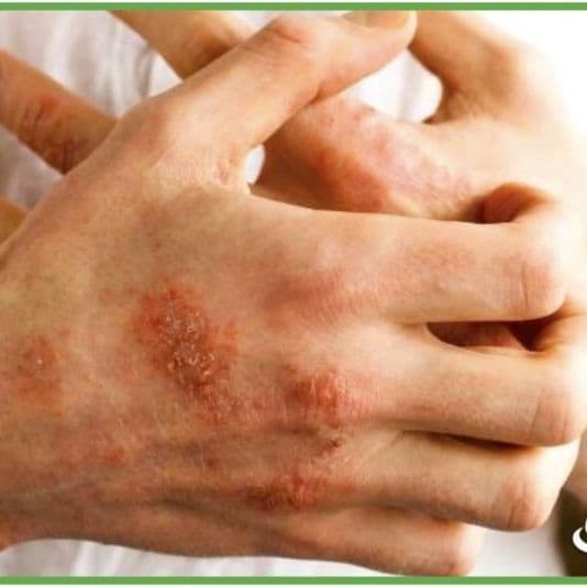 Eczema Medication, Eczema Medications Coupons