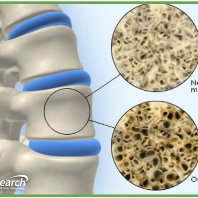 Osteoporosis Medication, Osteoporosis Medications Coupons