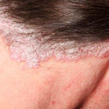 Psoriasis Medication, Psoriasis Medications Coupons, First